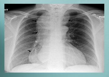 CHEST & ESOPHAGEAL